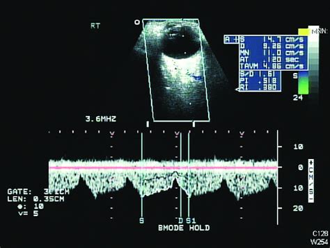 Orbital Colour Doppler Imaging Cdi Of Case 2 Demonstrates Reversed