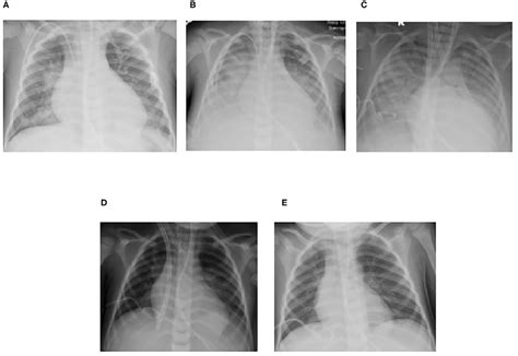 Serial Chest Radiographs For Case 2 Demonstrating The Progression And
