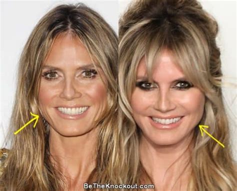 Heidi Klum Plastic Surgery Comparison Photos