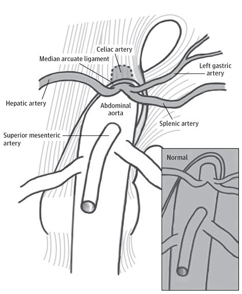 Median Arcuate Ligament Syndrome—review Of This Rare Disease