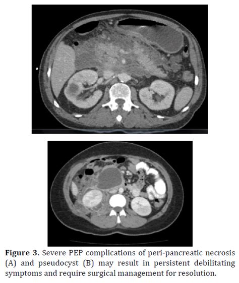 Prevention And Management Of Post Ercp Pancreatitis Insight Medical