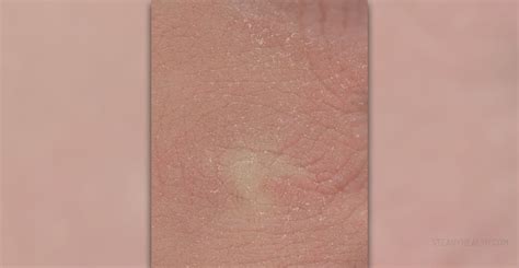Dry Patches On Skin General Center