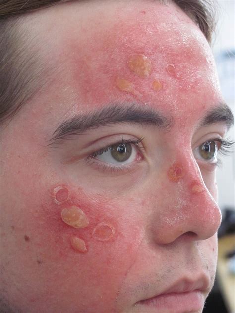 Sunburn Face Pictures Causes Symptoms Prevention And Treatment