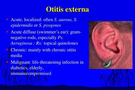 Ppt Upper Respiratory Tract Infections Powerpoint Presentation Id