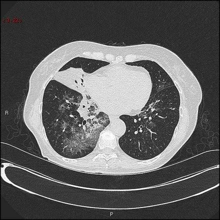 Lipoid Pneumonia Radiology Reference Article Radiopaedia Org