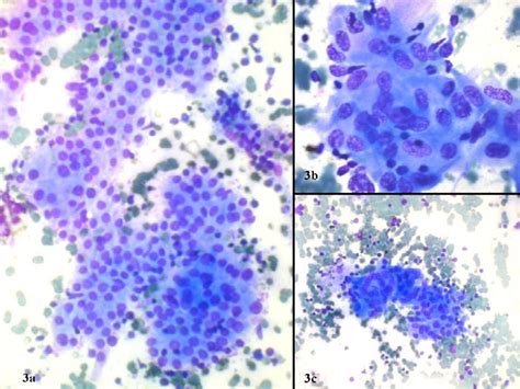 Lymphocytic Thyroiditis Is Cytological Grading Significant A