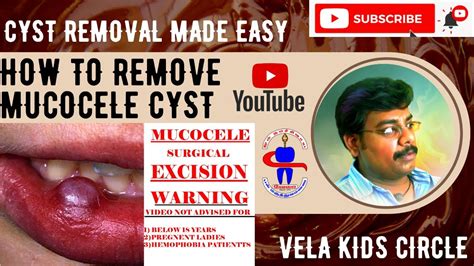 Cyst Removal Mucocele Excision Surgery Youtube