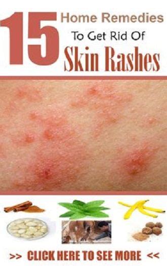 Top 15 Home Remedies To Get Rid Of Skin Rashes Styles Rage Home