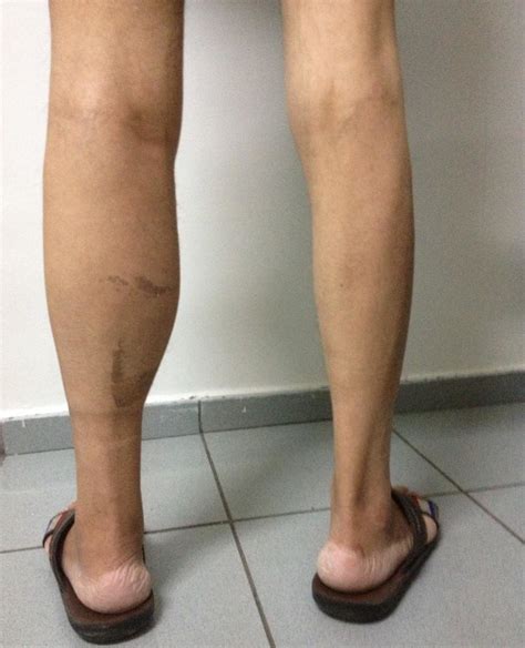 Figure A Swelling In The Left Leg Download Scientific Diagram