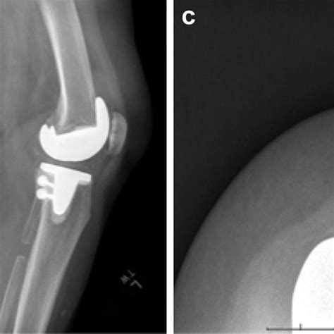 Pdf Proximal Tibiofibular Osteoarthritis Presenting As Pain After