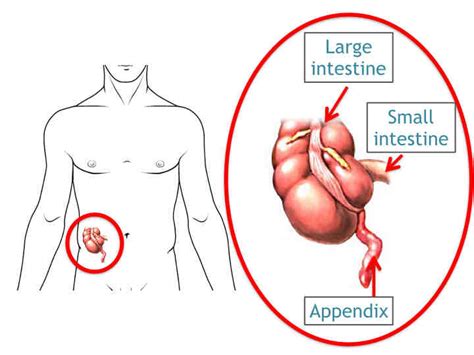 Appendix Removal Surgery Appendicitis Treatment In Mumbai Laparoscopy Surgery For Appendix