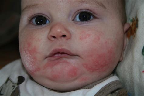 The causes of infectious rashes include a few drops of neem oil. Bacteria May Be A Key To Fighting Food Allergies ...