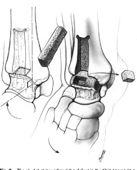 Figure 2 From Anterior Sliding Graft For Tibiotalar Arthrodesis