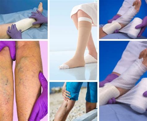 Guide To Venous Leg Ulcers Vein Solutions