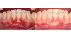 The gum is cut, pulled over the root and stitched. Do You Need a Gum Graft in Frisco? A Periodontist Explains