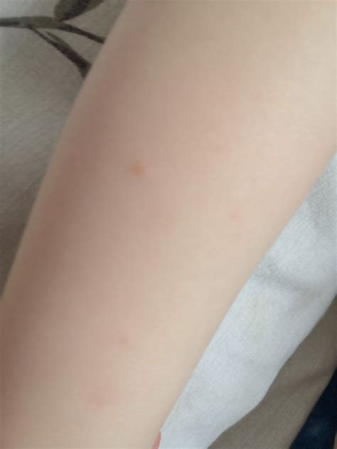 Сыпь на руках у ребёнка мелкоточечная Вопрос дерматологу 03 Онлайн