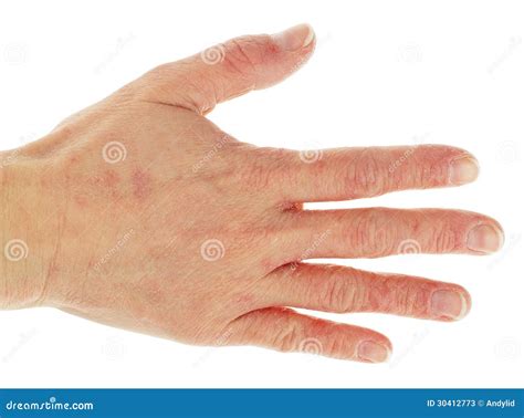 Eczema Dermatitis On Back Of Hand Stock Image Image Of Back Illness