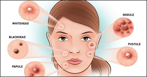A pimple is only a normal skin condition it affects the peoples in the form of inflammation of the skin. How To Prevent Pimples And Acne Naturally - 13 Tips