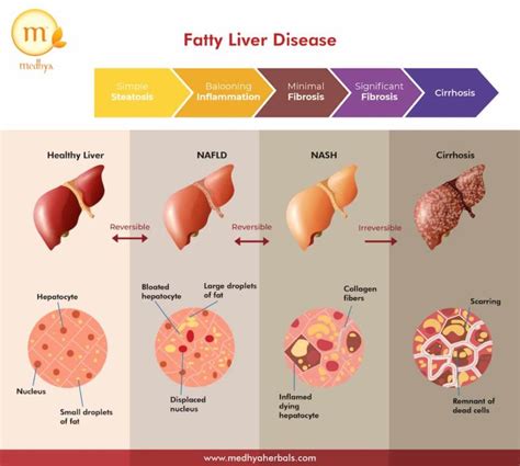 Fatty Liver Treatment The Best Ayurvedic Remedies To Cure Your Liver