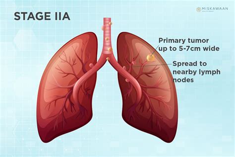 Lung Cancer Diagnosis Miskawaan Integrative Cancer Care