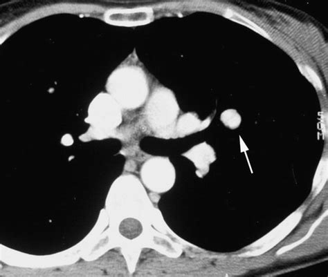 Bronchial Carcinoid Tumors Of The Thorax Spectrum Of Radiologic