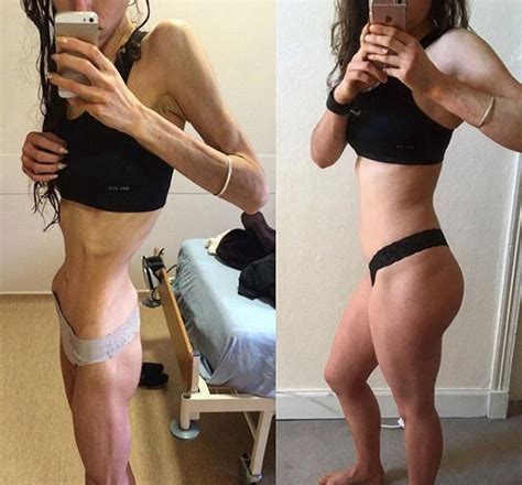 Mhairi Stewart Posts Before And After Anorexia Photos Daily Record