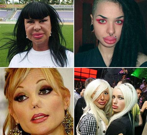 Irreversible Plastic Surgery Fails That Are Straight Up Scary Pics