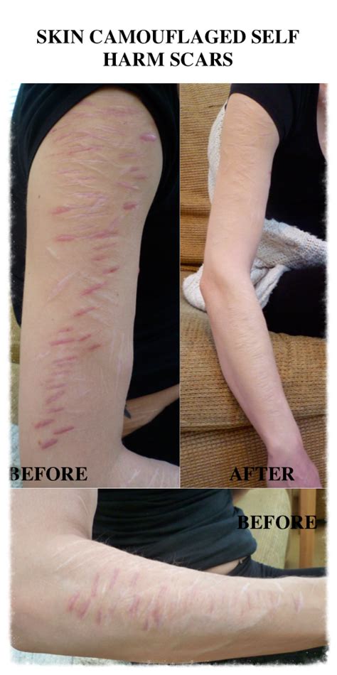 How To Cover Up Fresh Self Harm Cuts With Makeup Makeup Vidalondon