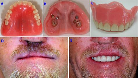 Oral Rehabilitation Of A Cleft Palate Patient With Tooth Supported