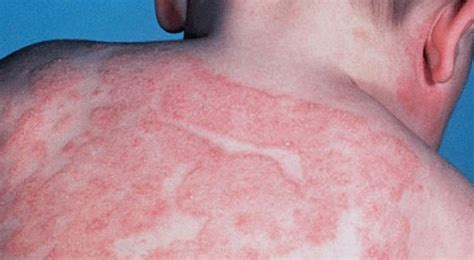 Eczema Atópico O Que é Causas Sintomas E Tratamentos Cura Natural