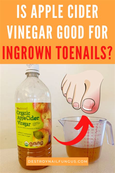 Treat Ingrown Toenail Apple Cider Vinegar Foot Soak Guide