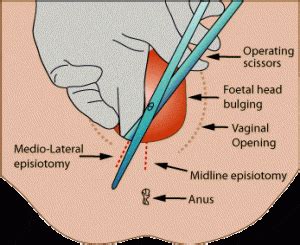 Medio Lateral Episiotomy Madriella Network