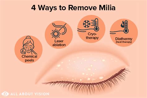 Milia Causes And Treatment All About Vision