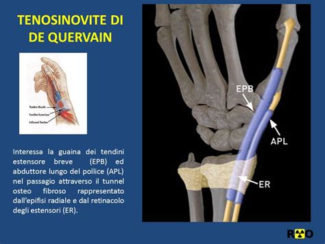 Tenosinovite Del Polso Di De Quervain Radiologia Ortopedica