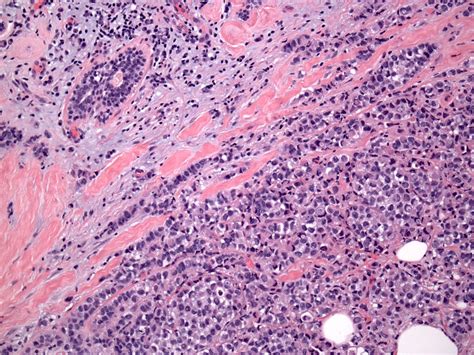 Pathology Outlines Pleomorphic Lobular Carcinoma