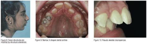 The Effects Of Enlarged Adenoids On A Developing Malocclusion Dental