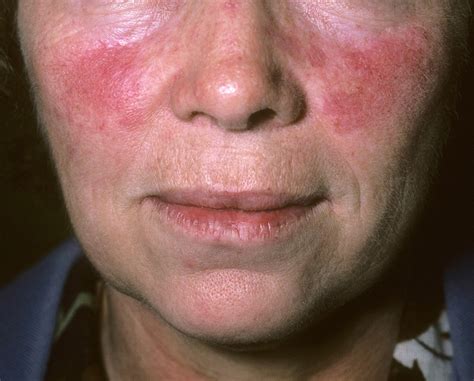 Monthly Intradermal Microinjections Of Tranexamic Acid Reduce Rosacea Symptoms Dermatology Advisor