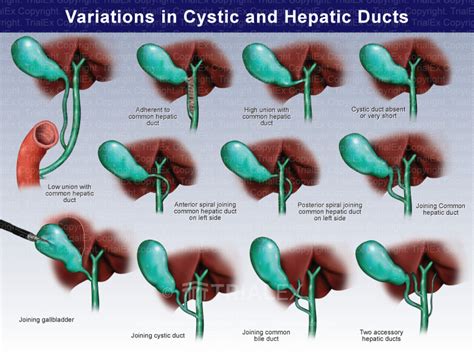 Variations In Cystic And Hepatic Ducts Trial Exhibits Inc