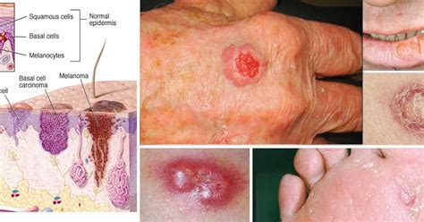 Stages Of Basal Cell Carcinoma Skin Cancer Types Of Most Common