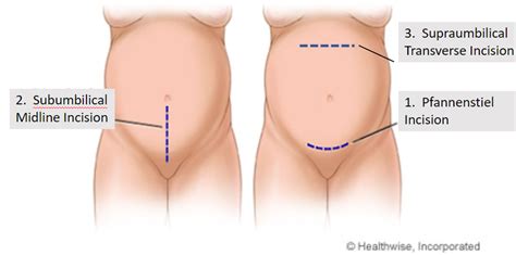 Abdominal Surgical Incisions
