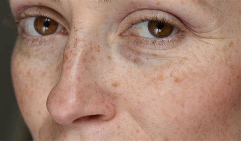 Treating Sun Damage And Sun Spots Dr Haus Dermatology