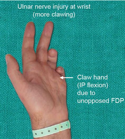Ulnar Nerve Lesions Causes Diagnosis