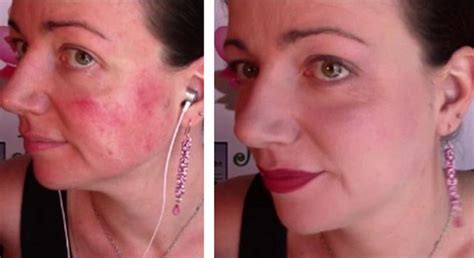 The Rosacea Treatments That Worked For Me The Healthy