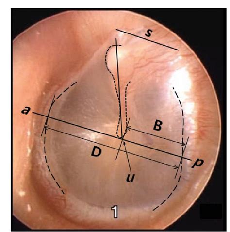 Figure 1 From Video Pneumatic Otoscopy For The Diagnosis Of Conductive