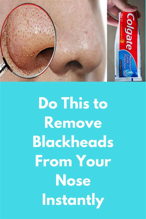 How To Remove Blackheads On Nose Quickly Howtoremvo