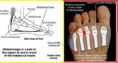 Metatarsalgia Treatment Symptoms Exercises Shoes Causes