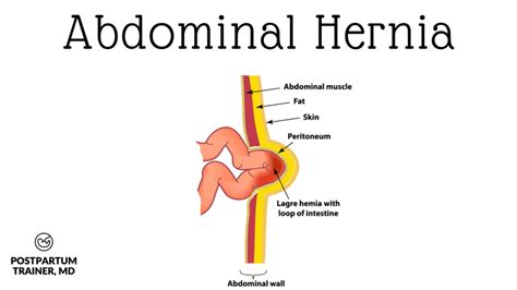 Diastasis Recti Or Hernia How To Tell The Difference After Pregnancy