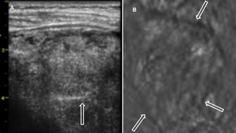 Benign Thyroid Nodule With Degenerative Changes A B Mode Us Of