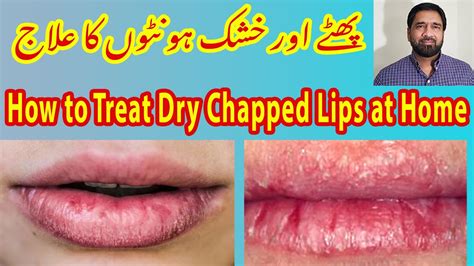 Dry Chapped Lips Remedy Dry Lips Treatment Best Remedy For Dry Lips