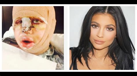 Kylie Jenner Before and After Plastic Surgery - YouTube